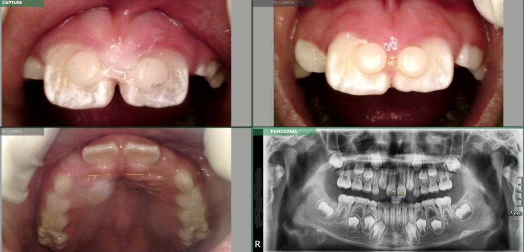 Lucas L – 8yo – Close Diastema before MFT – Class II div 1 and 2 Mixed Dentition